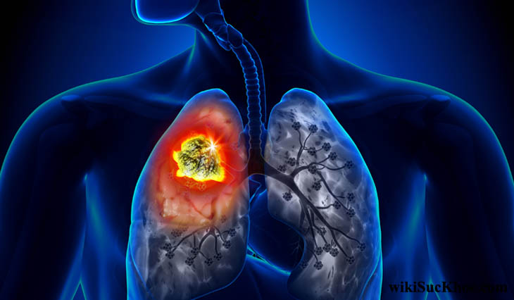 Bệnh ung thư phổi: Khái niệm, nguyên nhân, triệu chứng, phòng ngừa