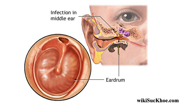 Bệnh viêm tai giữa: Khái niệm, nguyên nhân, triệu chứng, phòng ngừa