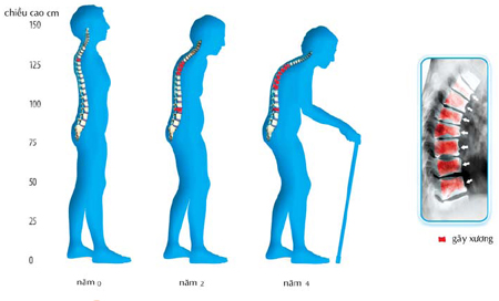 Nhiều bài thuốc có thể trị bệnh loãng xương