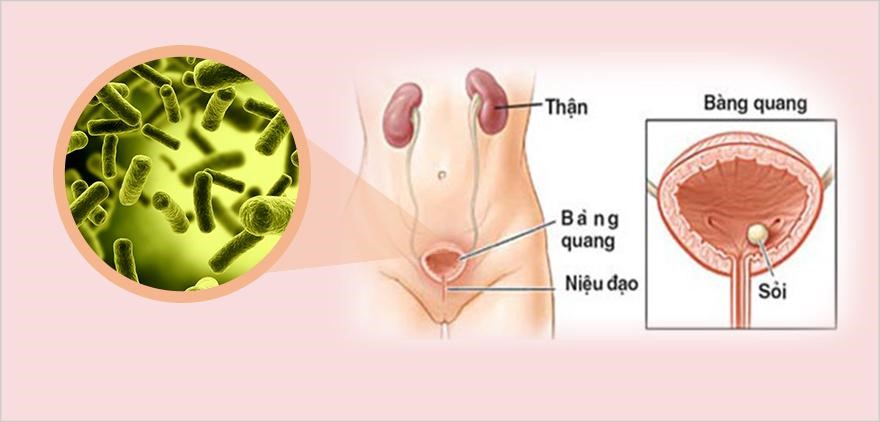 Bàng quang bị nhiễm khuẩn