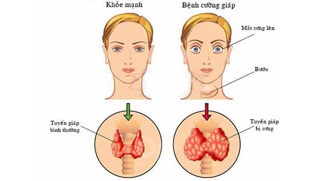 Bệnh bướu cổ xuất hiện do tuyến giáp bị sưng