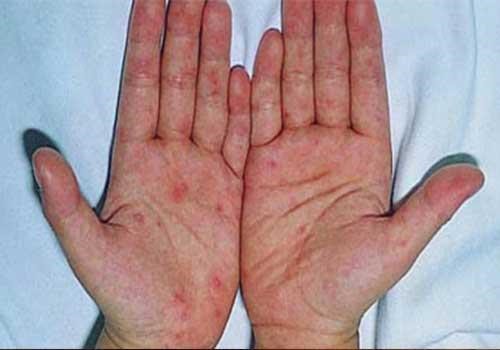 Bệnh chàm với dấu hiệu nổi mụn nước