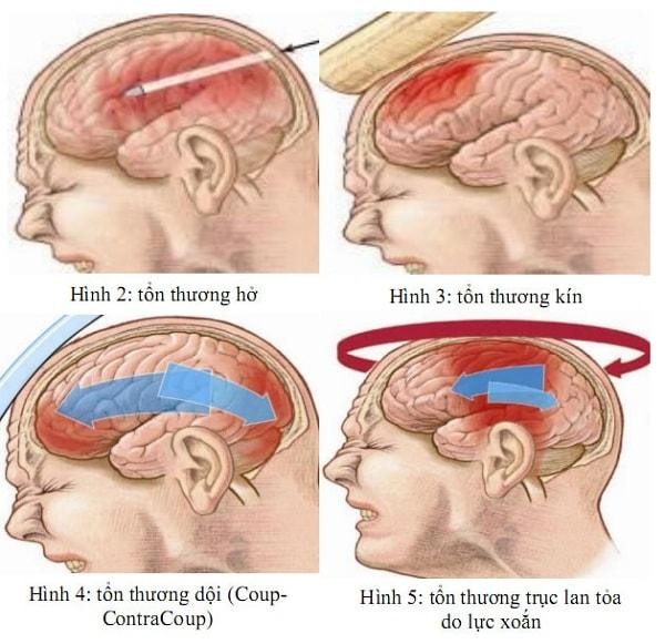 Bệnh chấn thương sọ não là gì?