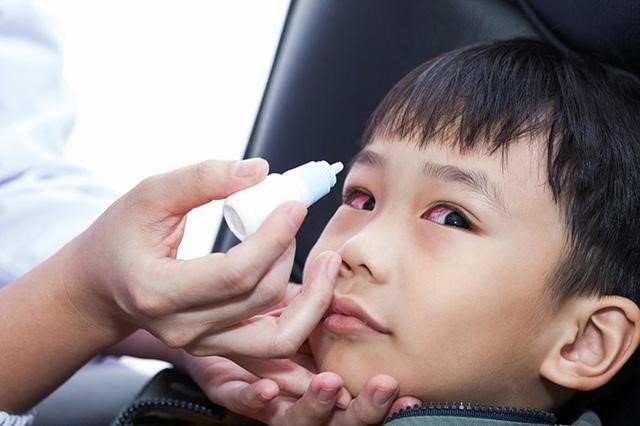 Bệnh đau mắt đỏ dễ bị lây lan, truyền nhiễm