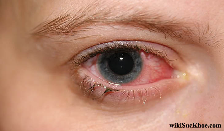 Bệnh đau mắt đỏ: Khái niệm, nguyên nhân, triệu chứng, phòng ngừa