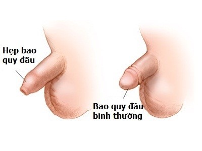 Bệnh hẹp bao quy đầu