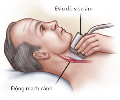 Bệnh hẹp động mạch cảnh