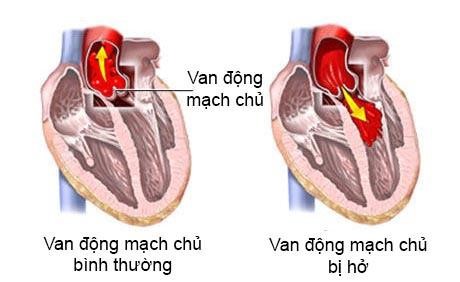 Bệnh hở van động mạch chủ