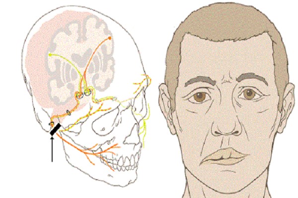 Bệnh liệt mặt trung ương