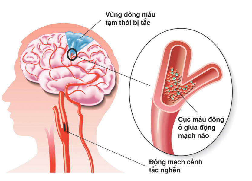 Khái niệm bệnh mạch máu não