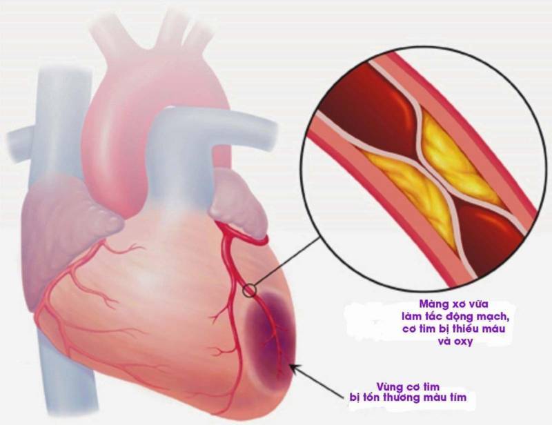 Bệnh nhồi máu cơ tim