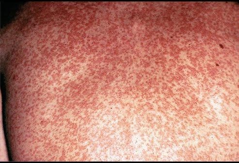 Bệnh Rubella dễ bị lây nhiễm