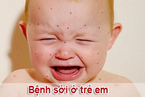 Bệnh sởi là bệnh như thế nào?