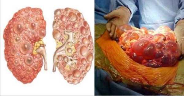 Bệnh sỏi thận gây ách tắc đường tiểu và cuống đài thận