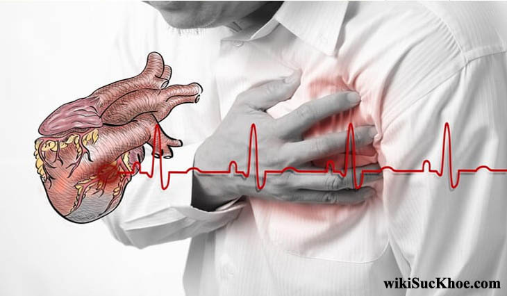 Bệnh suy tim: Khái niệm, nguyên nhân, triệu chứng, phòng ngừa