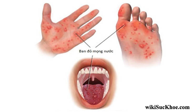 Bệnh chân tay miệng: Khái niệm, nguyên nhân, triệu chứng, phòng ngừa
