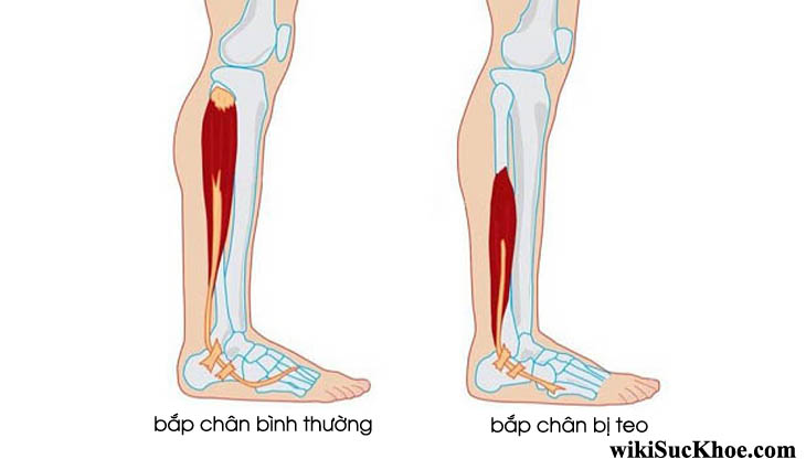 Bệnh teo cơ bắp chân là gì ?