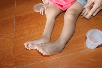 Bệnh teo cơ làm mất cân xứng cơ giữa hai chân