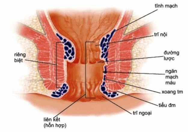 Bệnh trĩ ngoại là gì ?