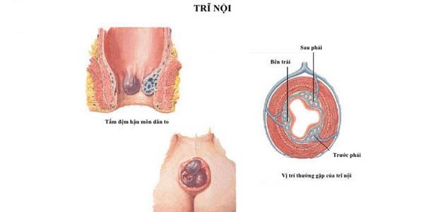 Bệnh trĩ nội là gì ?
