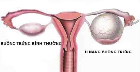 Bệnh u nang buồng trứng có nguy hiểm không?