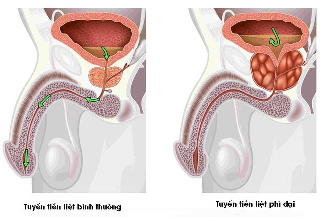 Bệnh u xơ tuyến tiền liệt