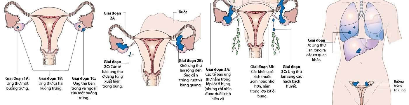 Bệnh ung thư buồng trứng phát triển qua những giai đoạn