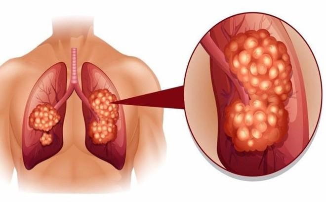 Bệnh ung thư phổi gây hại tới tính mạng con người