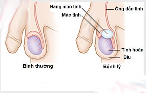 Bênh ung thư tinh hoàn