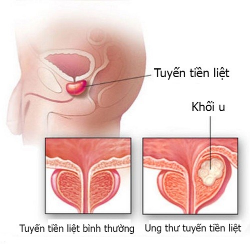 Bệnh ung thư tuyến tiền liệt