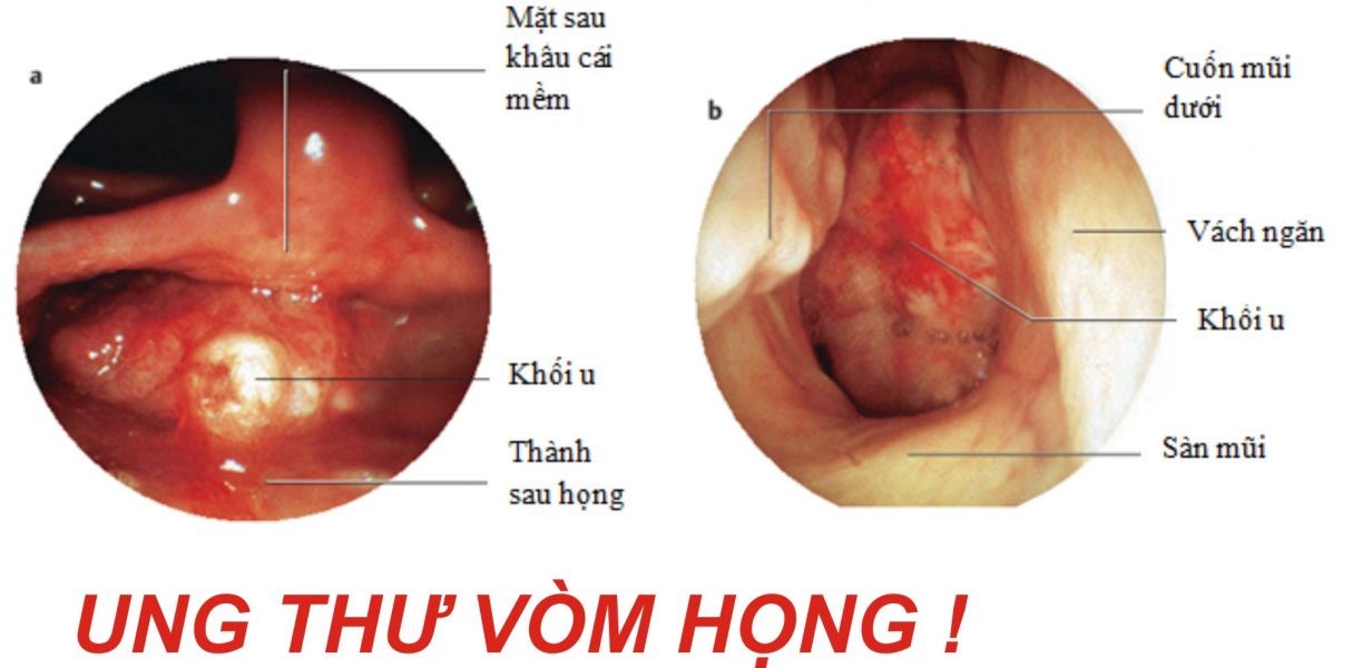 Hình ảnh của bệnh ung thư