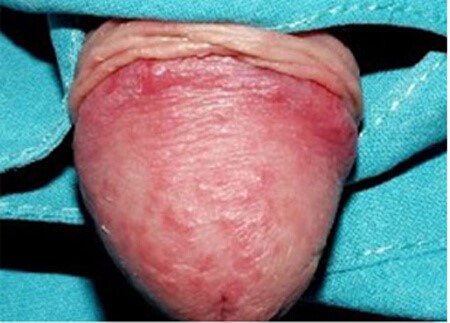 Hình ảnh của người bị viêm bao quy đầu