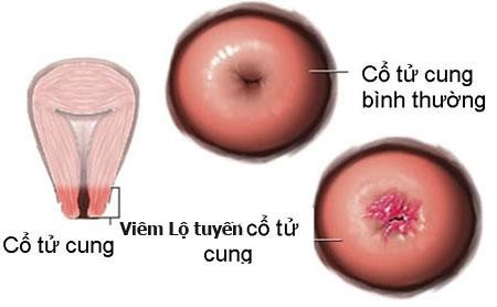 Bệnh viêm cổ tử cung là bệnh phụ khoa dễ mắc
