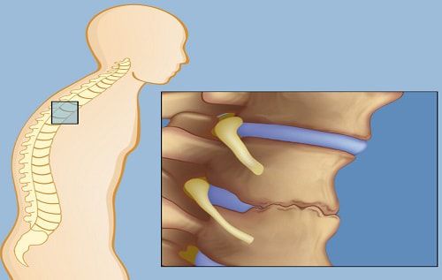 Bệnh viêm cột sống dính khớp được gây ra bởi nhiều nguyên nhân