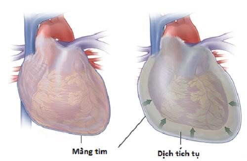 Bệnh viêm màng ngoài tim rất dễ gây độc toàn thân