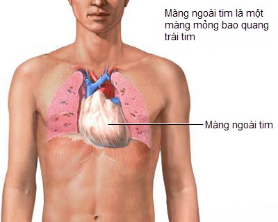 Bệnh viêm màng ngoài tim