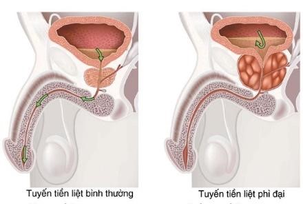 Bệnh viêm tuyến tiền liệt được chữa theo nhiều cách khác nhau