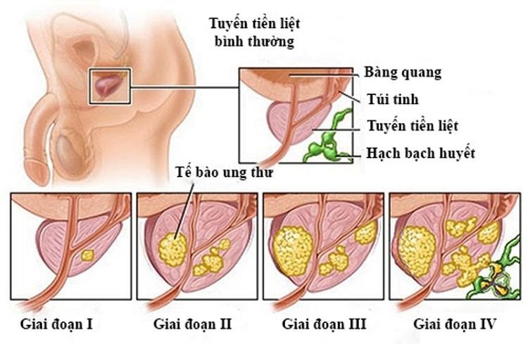 Bệnh viêm tuyến tiền liệt qua các giai đoạn