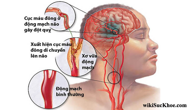 Bệnh xuất huyết não: Khái niệm, nguyên nhân, triệu chứng, điều trị, cách phòng ngừa