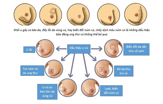 Các dấu hiệu ung thư vú