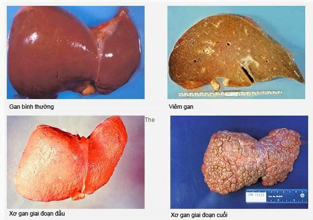 Các giai đoạn mắc bệnh xơ gan