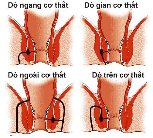 Các loại rò hậu môn mà các bạn cần biết