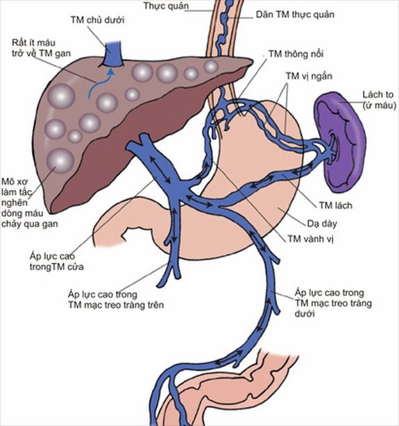 Các mạch máu tại vị trí giãn tĩnh mạch dễ vỡ và gây chảy máu thực quản