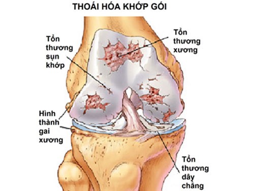 Các quy trình của bệnh thoái hóa khớp