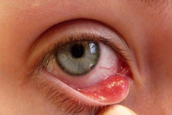 Cách chữa bệnh tắc tuyến lệ ở người lớn và trẻ em