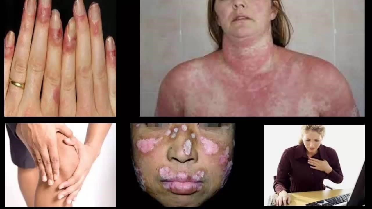 Cách phòng tránh bệnh lupus ban đỏ