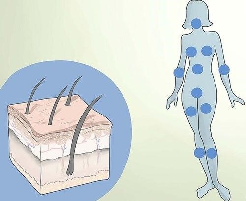 Đa nang buồng trứng là một bệnh mất cân bằng nội tiết tố