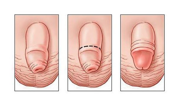 Hình ảnh bệnh dài bao quy đầu ở trẻ nhỏ