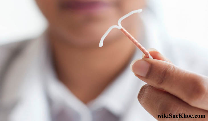Đặt vòng tránh thai: Những thông tin nên biết