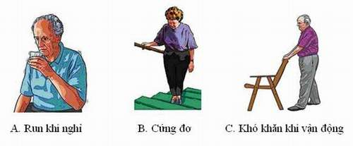 Dấu hiệu bệnh parkinson